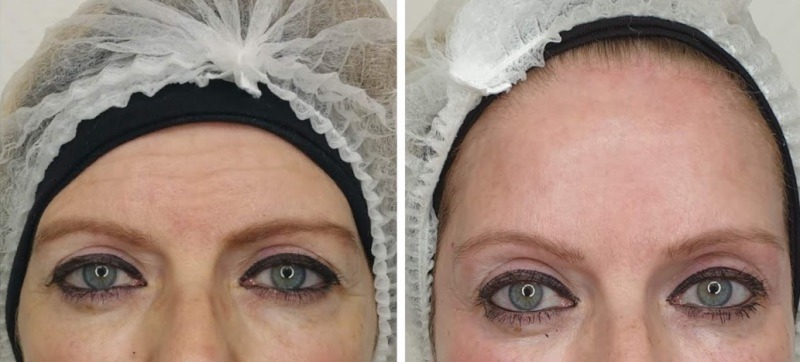 injection botox montpellier