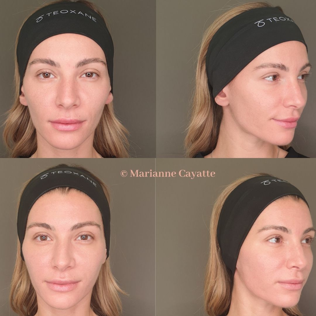 Microneedling montpellier Microneedling montpellier