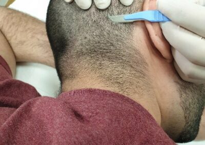 Microgreffes avec Rigenera