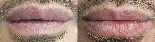 injections bouche Hommes injections bouche Hommes