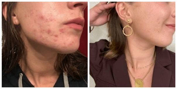 Cicatrices avant après Cicatrices avant après