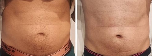 Cryolipolyse avant après Homme Cryolipolyse avant après Homme