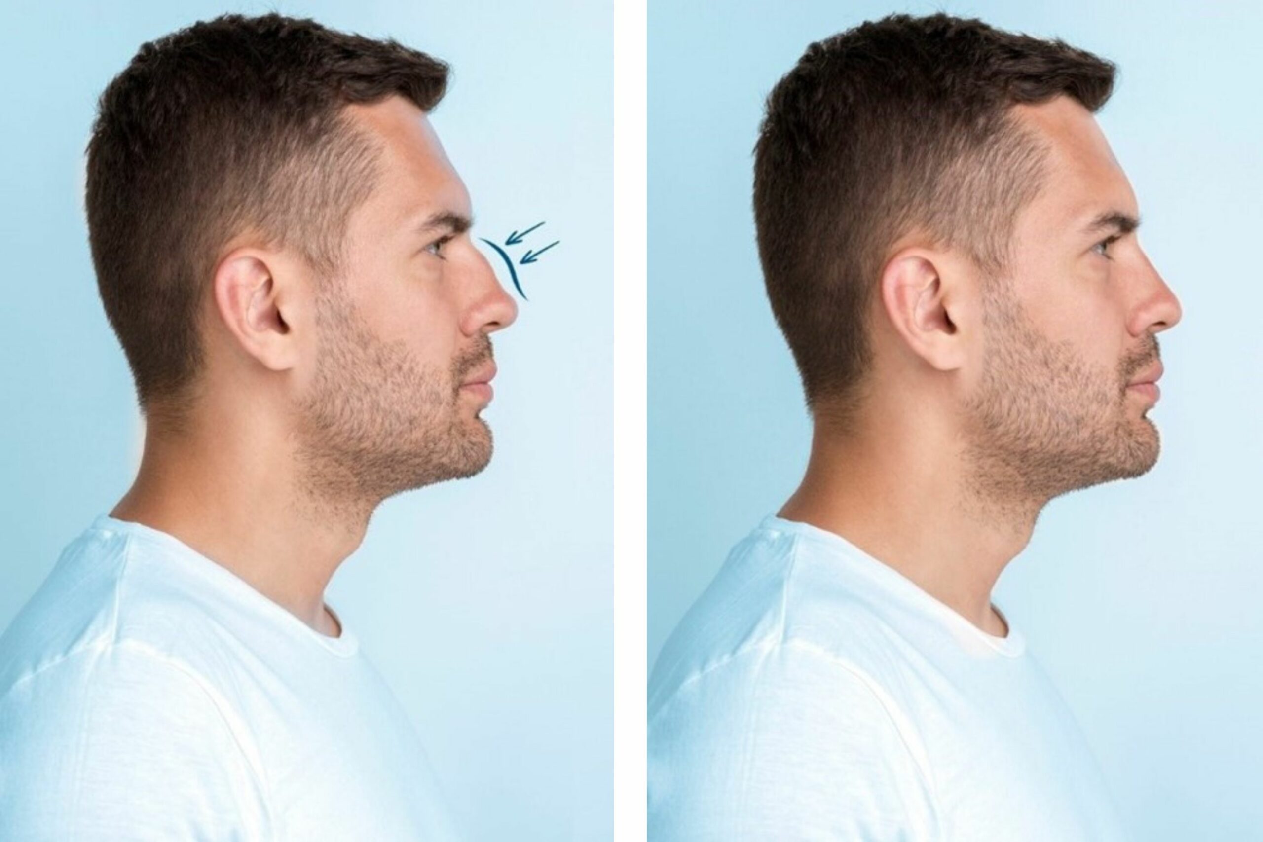 rhinoplastie homme rhinoplastie homme