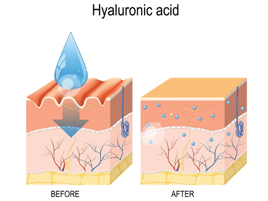 Acide hyaluronique rides Acide hyaluronique rides