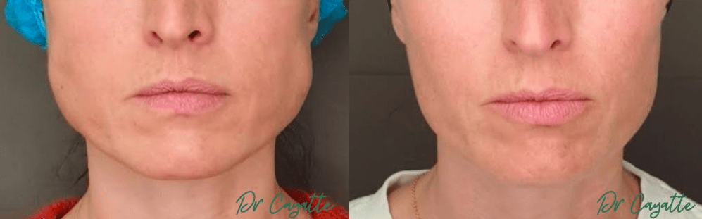 Botox Masseters avant après Botox Masseters avant après