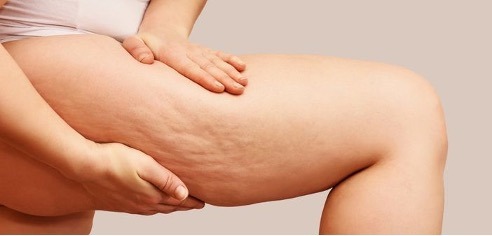 Cellulite Aqueuse Cellulite Aqueuse