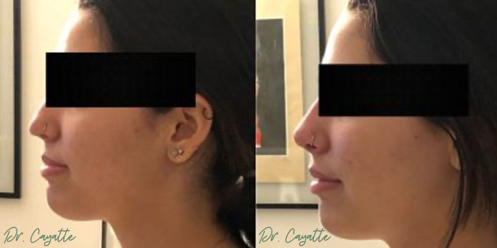Injections avant après profiloplastie Injections avant après profiloplastie