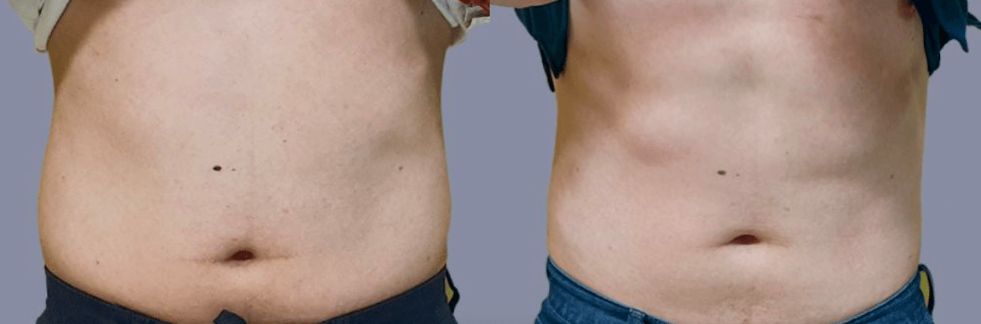 Radiofréquence Pro Shape II Avant Après Ventre Radiofréquence Pro Shape II Avant Après Ventre
