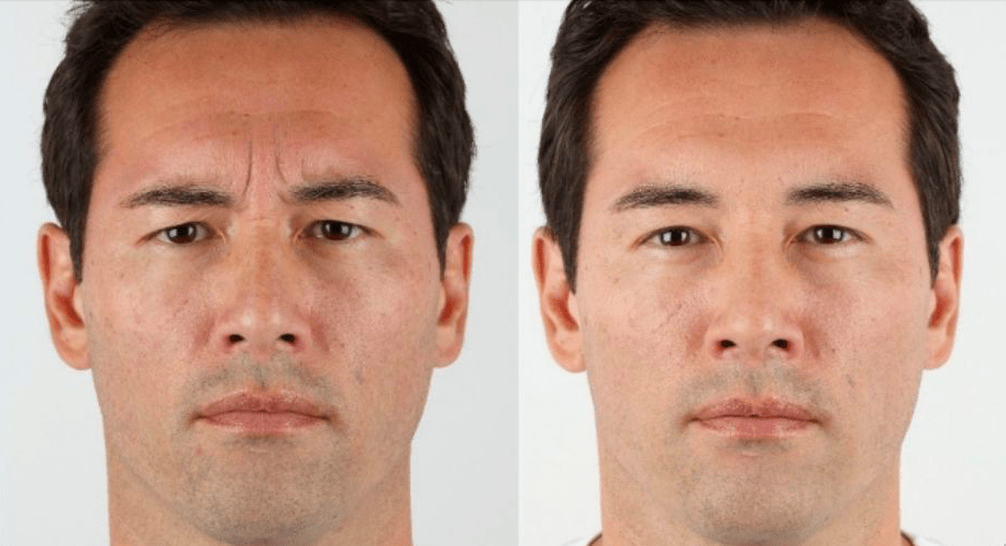 Rajeunissement Frontal Botox Rajeunissement Frontal Botox