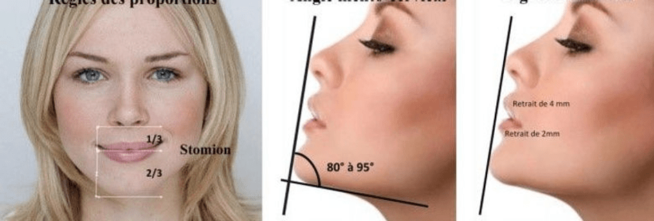 Traitement Profiloplastie Traitement Profiloplastie