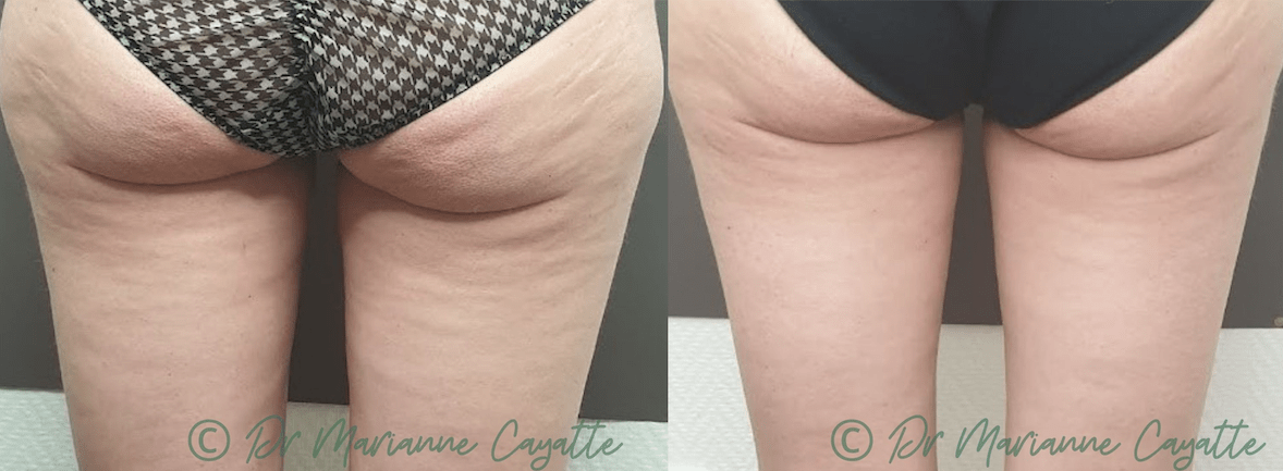 traitement cellulite montpellier traitement cellulite montpellier