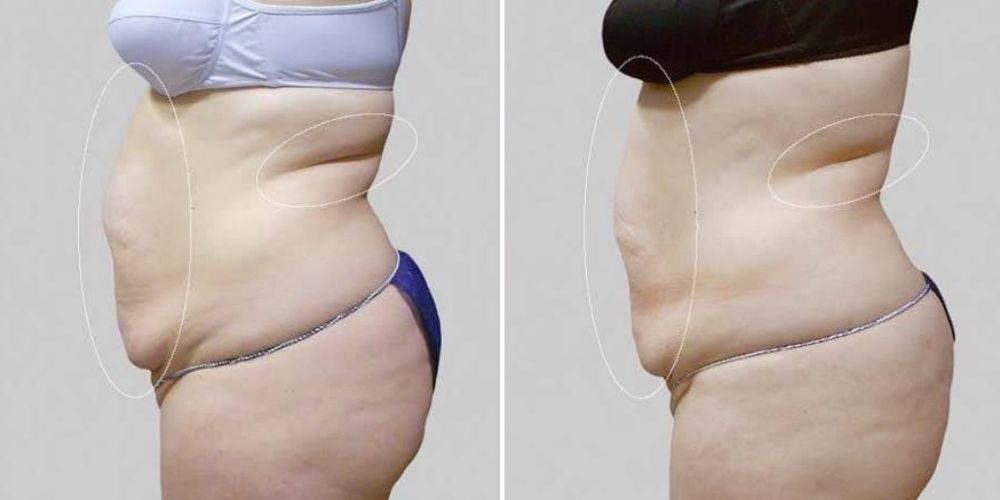 cryolipolyse LIPOCONTRAST avant après cryolipolyse LIPOCONTRAST avant après