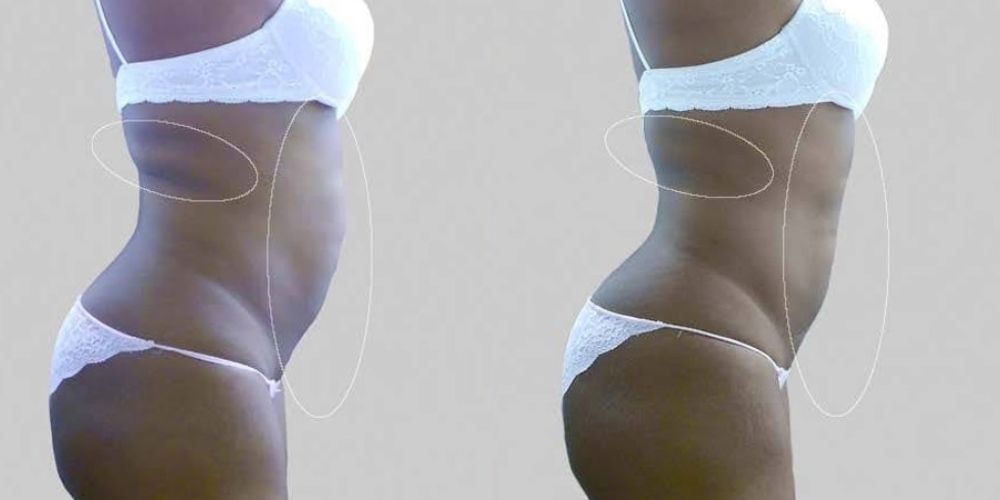 cryolipolyse lipocontrast avant après cryolipolyse lipocontrast avant après